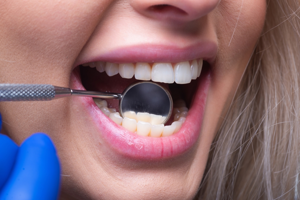 Dental clinic. Teeth examined at dentists. Healthy woman teeth and a dentist mouth mirror. Ideal teeth. Dental tools ant white tooth. Close up womans teeth with dental mirror. Dental treatment.
