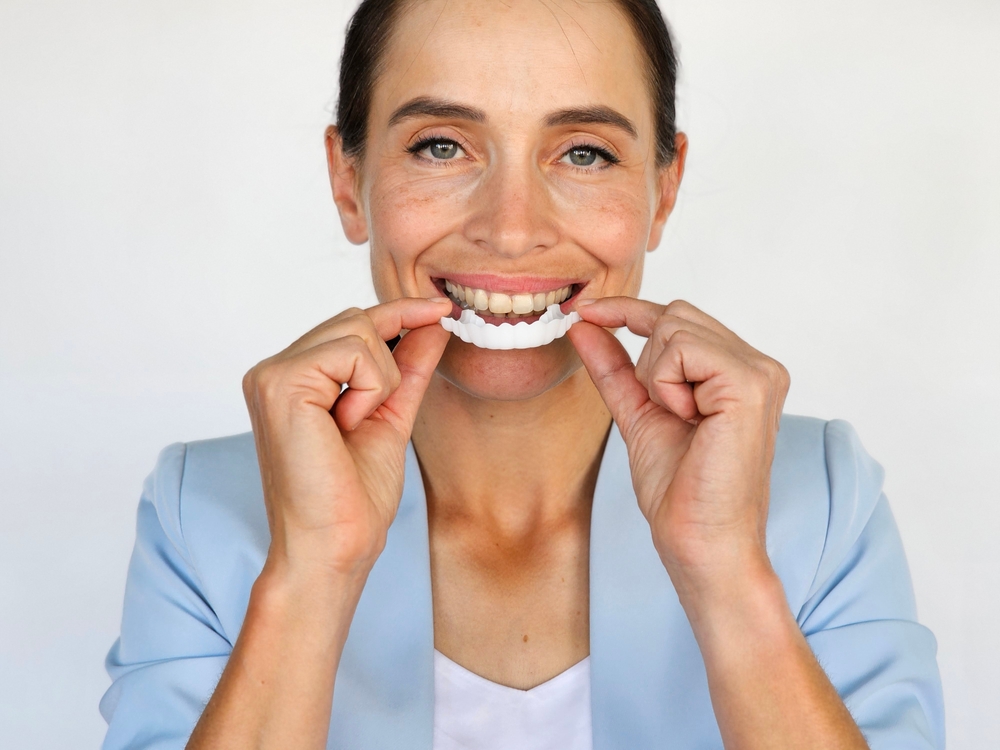 Woman demonstrates applying aligner while smiling. Teeth overlay, perfect fit, teeth whitening and snap-on silicone smile veneers
